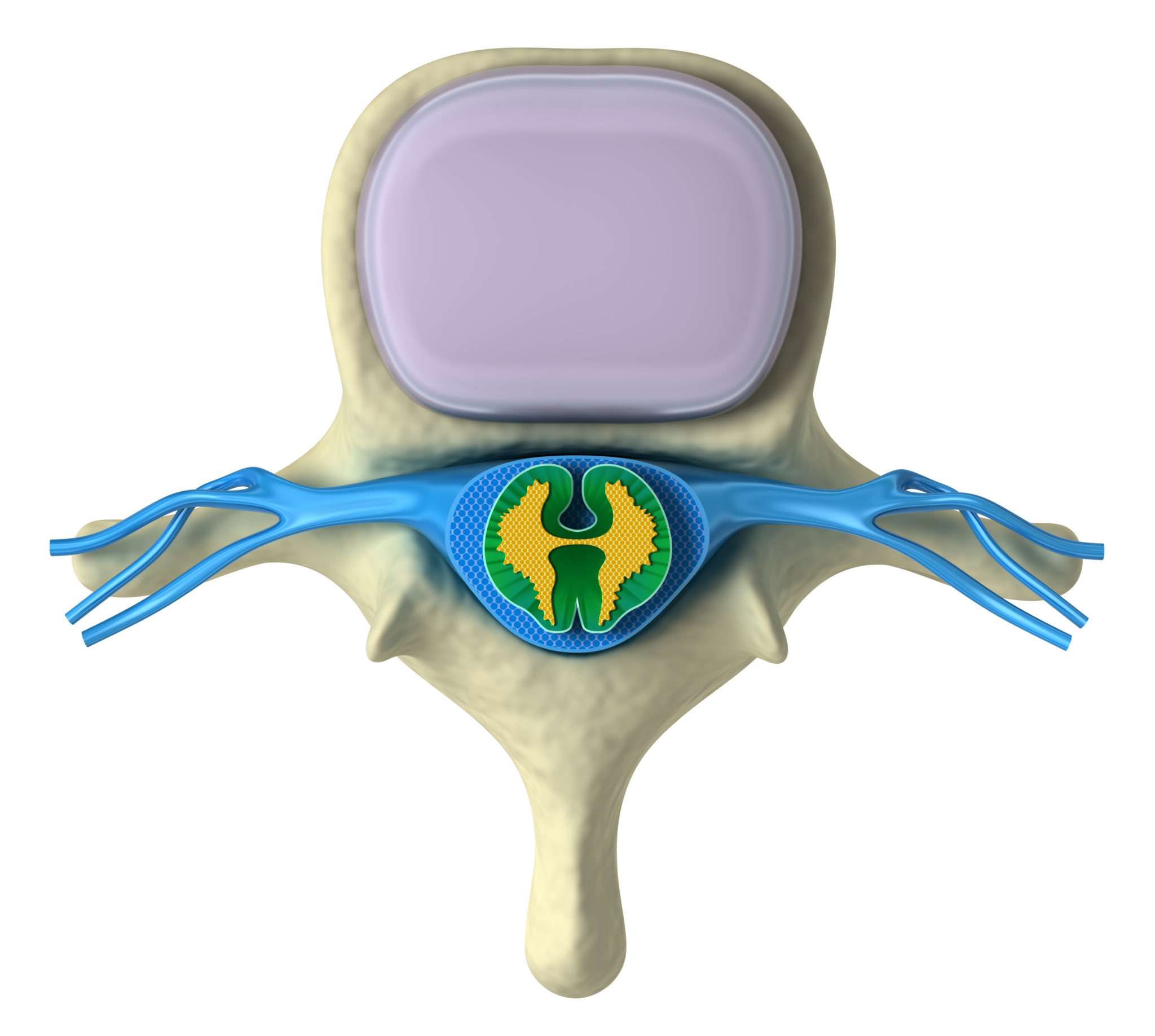 Vertebral Complex Disc Degenerative Disc Study - Corey Hunter, MD