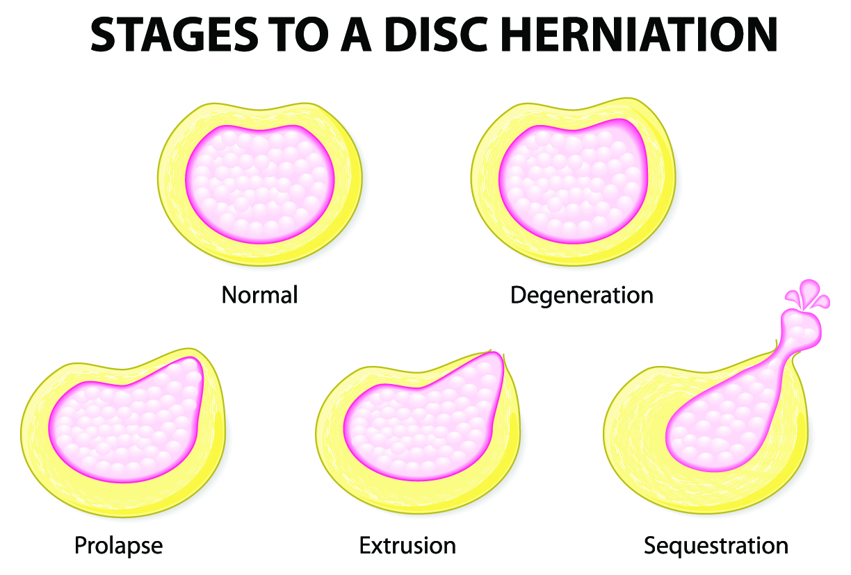 Stages Of Degenerative Disc Disease Neck